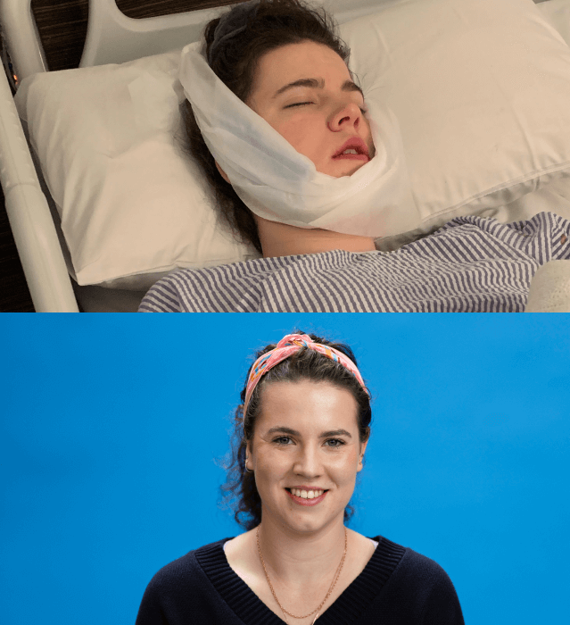 Before and after image of Saskia after treatment